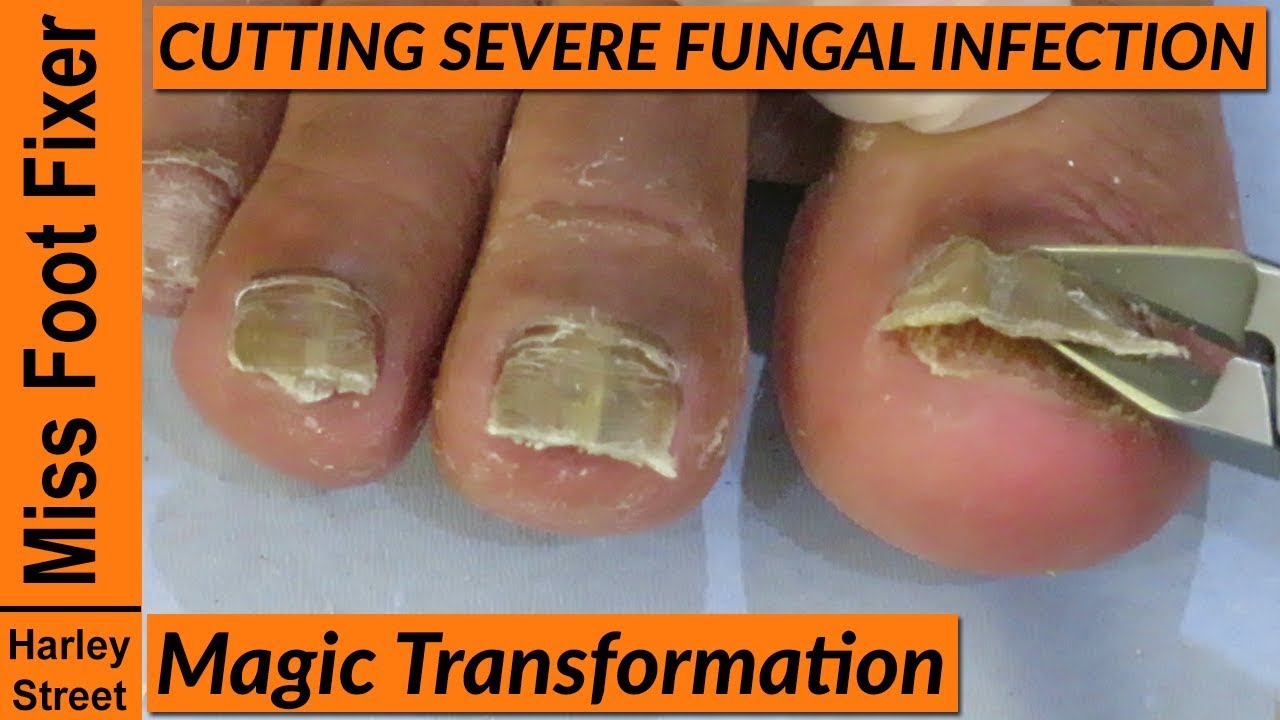 Concord Foot Doctor Explains How to Eliminate Toenail Fungus Naturally | by  Alexa Camron | Medium